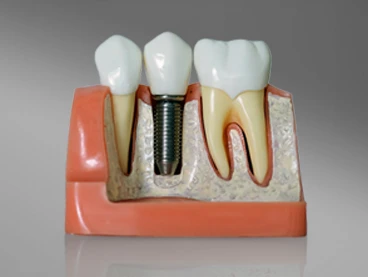 Oral Implantology